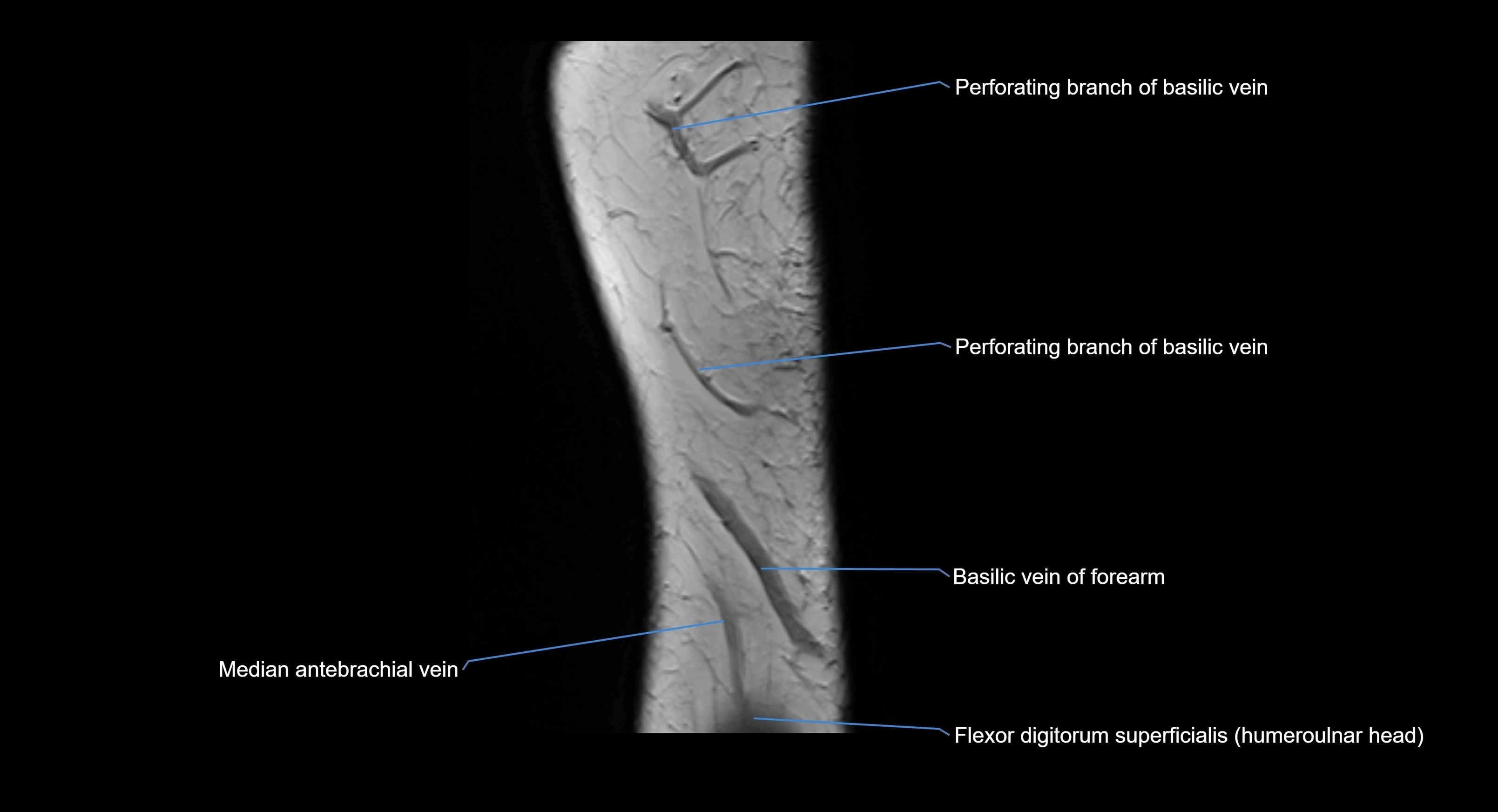 MRI elbow joint  sagittal cross sectional anatomy 3T  radiology  image-img-00001-00003.webp